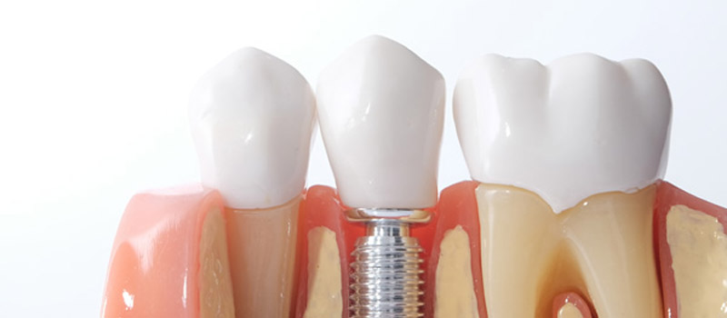 dental implants in kandivali