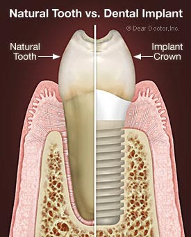 dental implants in kandivali