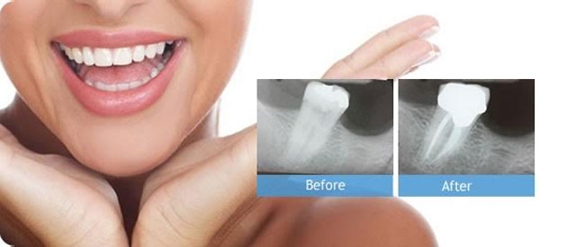 Root Canal Treatments in Kandivali