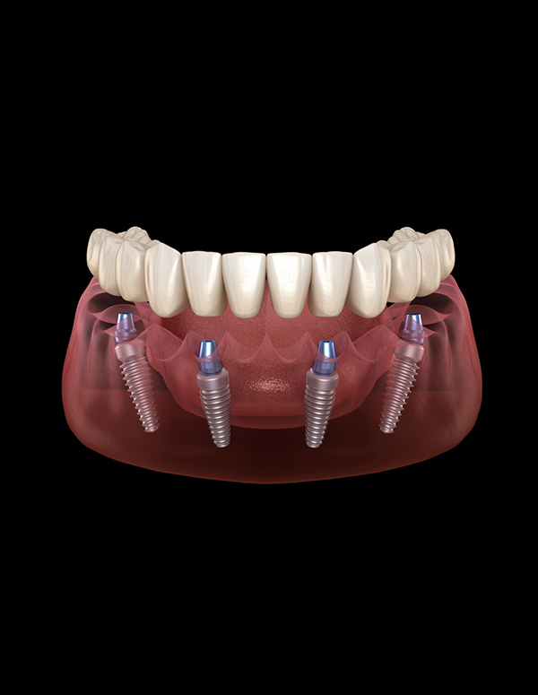 Dental Implants in kandivali