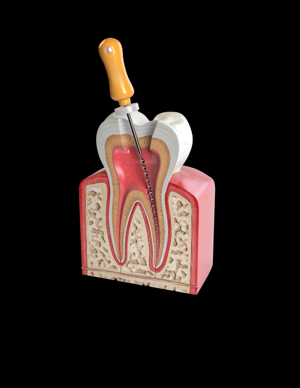 Root Canal Treatment in kandivali