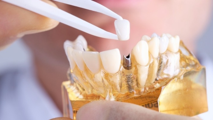 Dental Implants in Kandivali